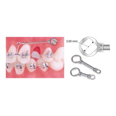 TruFlex NiTi TAD Closed...